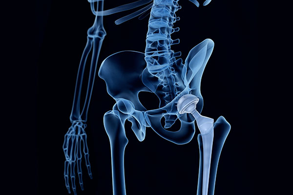 An X-ray of hip replacement. Healthy Walk Physical Therapy and Rehabilitation Iselin, NJ